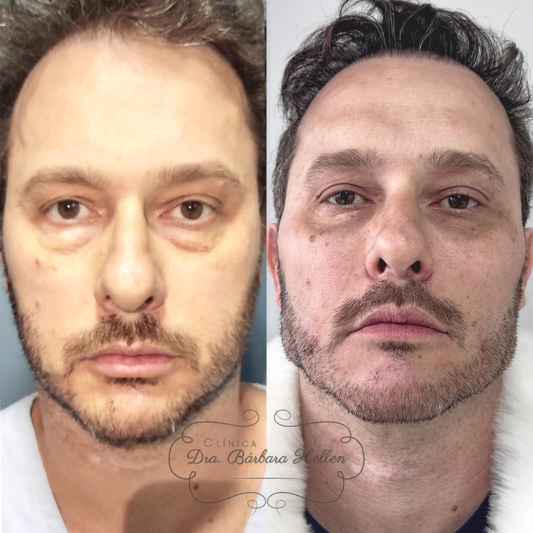 Comparação de antes e depois de paciente da clínica, caso 02