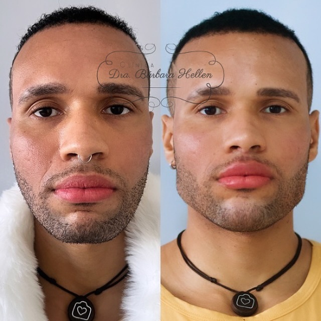 Comparação de antes e depois de paciente da clínica, caso 04
