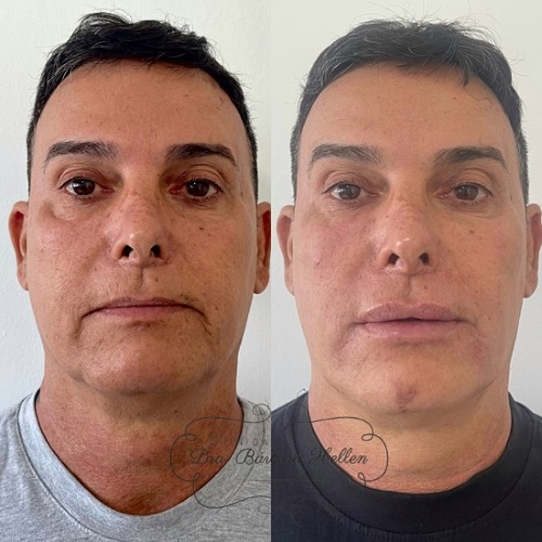 Comparação de antes e depois de paciente da clínica, caso 06