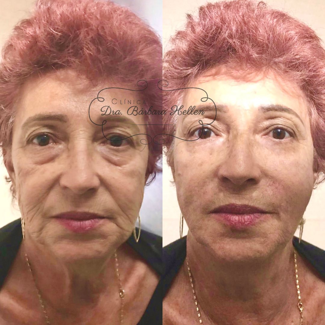 Comparação de antes e depois de paciente da clínica, caso 07